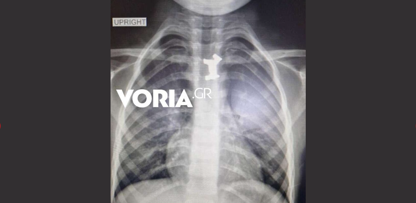 Θεσσαλονίκη: Στο νοσοκομείο αγοράκι 4,5 ετών που κατάπιε μεταλλικό πιόνι (φωτο)