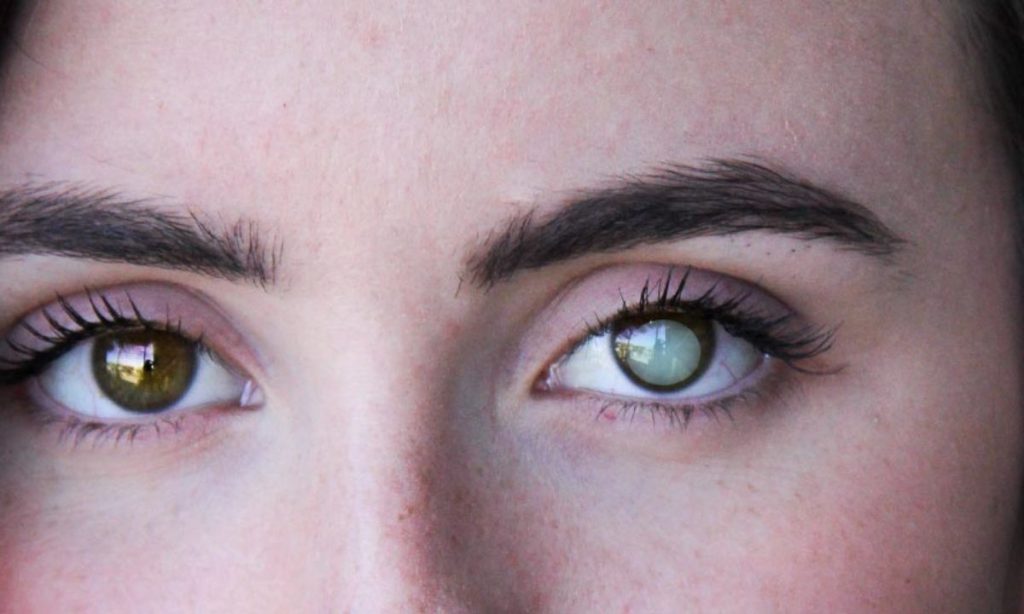 Καταρράκτης: Τα 6 «ύπουλα» σημάδια που πρέπει να γνωρίζετε