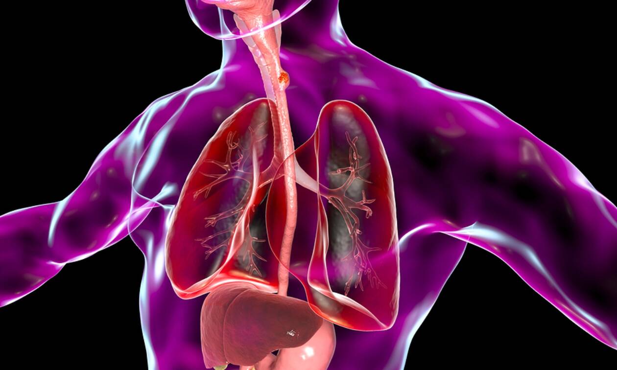 Οισοφάγος Barrett: Πόσο αυξάνει τον κίνδυνο καρκίνου του οισοφάγου; – Πώς γίνεται η διάγνωση;