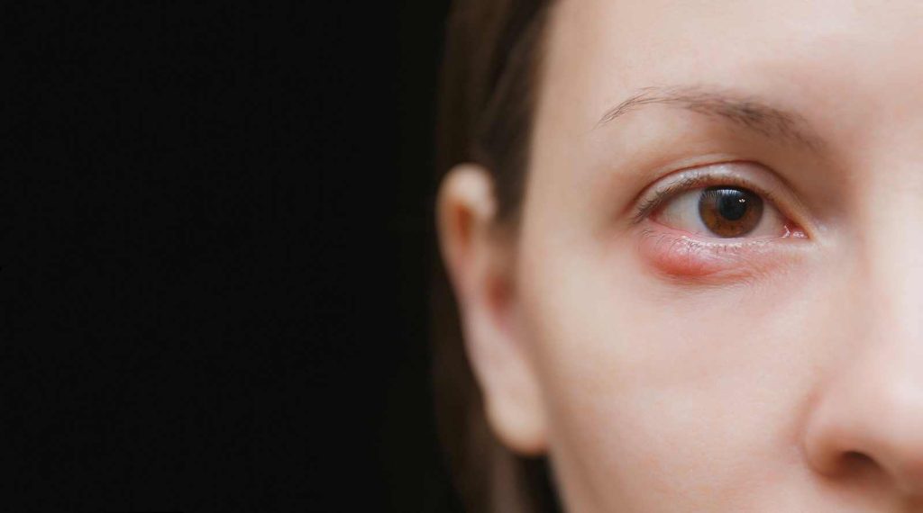 Κριθαράκι στο μάτι: Σπιτικές θεραπείες για να το «εξαφανίσετε»