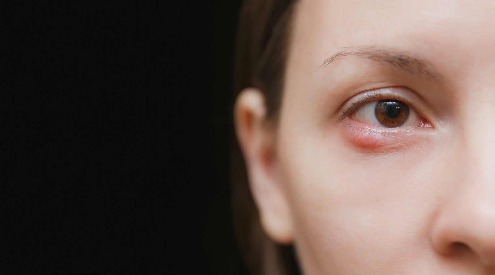 Κριθαράκι στο μάτι: Σπιτικές θεραπείες για να το «εξαφανίσετε»