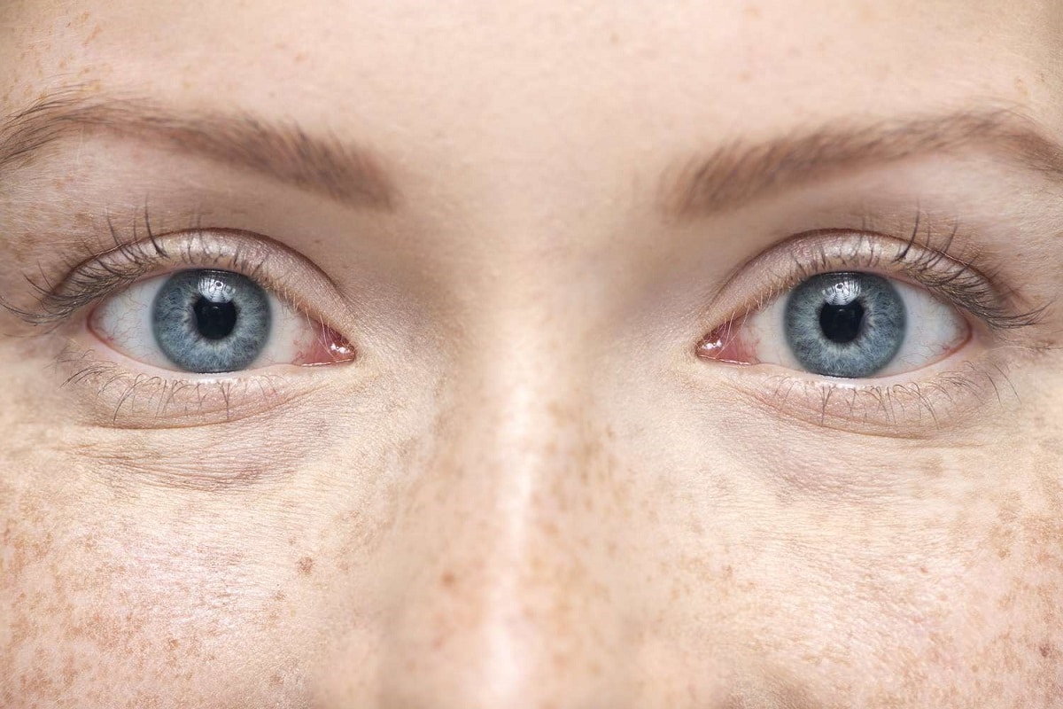 Τα τρία σημάδια στα μάτια που φανερώνουν ότι έχετε υψηλή χοληστερίνη