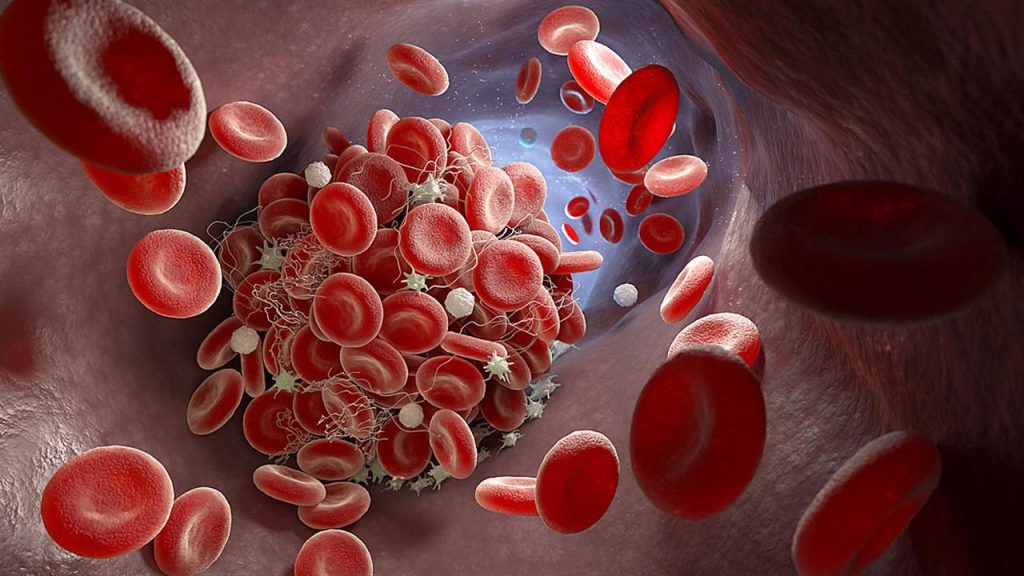 Χαμηλά αιμοπετάλια: Δείτε ποια είναι τα συμπτώματα της θρομβοπενίας και πώς αντιμετωπίζεται