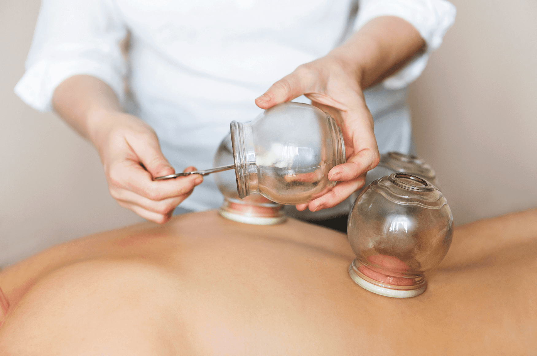 Βεντούζες με ποτήρια: Όσα πρέπει να γνωρίζετε για το παλιό γιατροσόφι