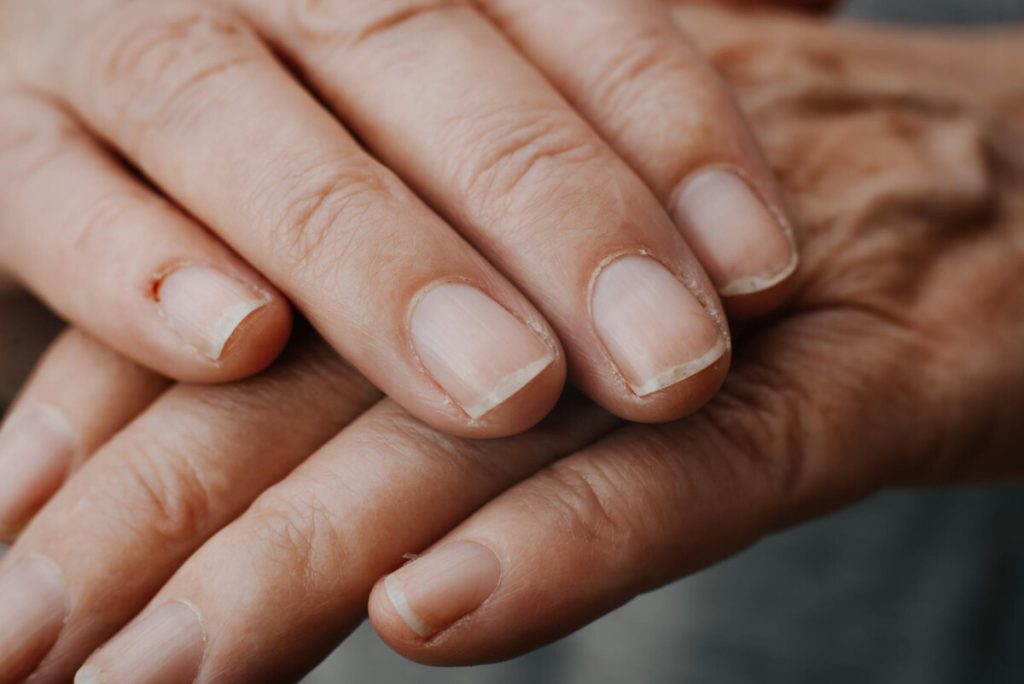 Το σημάδι στα νύχια σας που μπορεί να είναι ένδειξη για συχνό καρκίνο