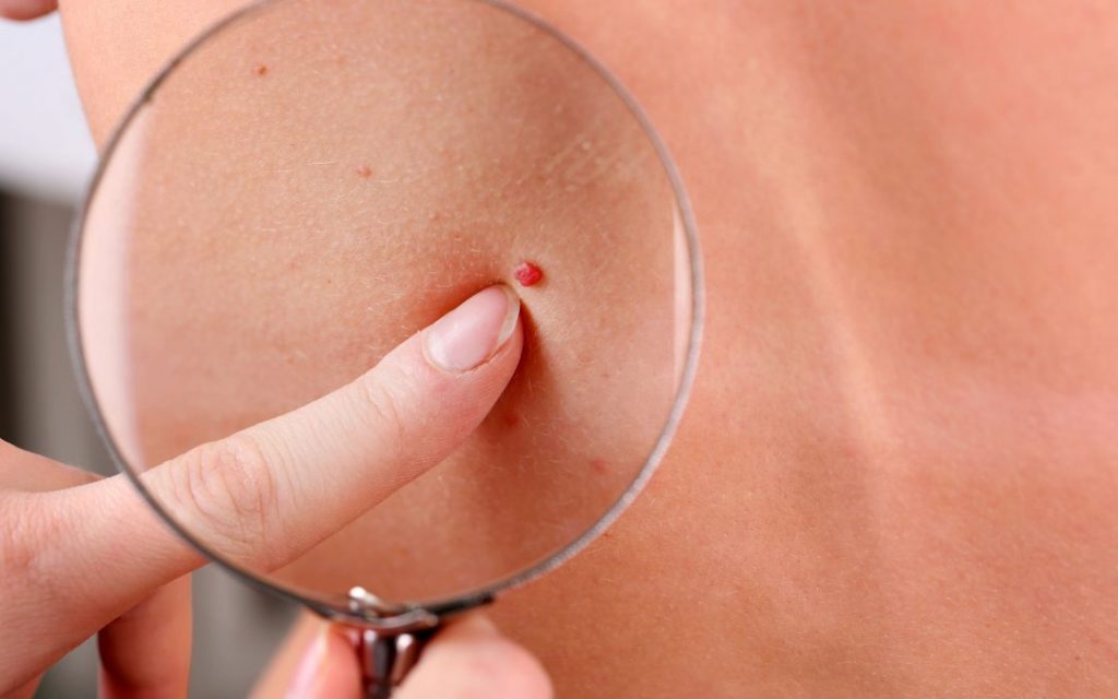 Κόκκινες ελιές στο δέρμα: Πώς προκαλούνται και πώς αντιμετωπίζονται;