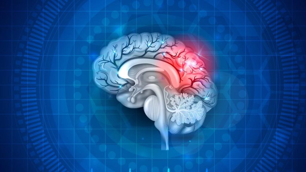 Μελέτη: Η σωματική δραστηριότητα μετά από ένα εγκεφαλικό είναι καθοριστικής σημασίας για την ανάρρωση