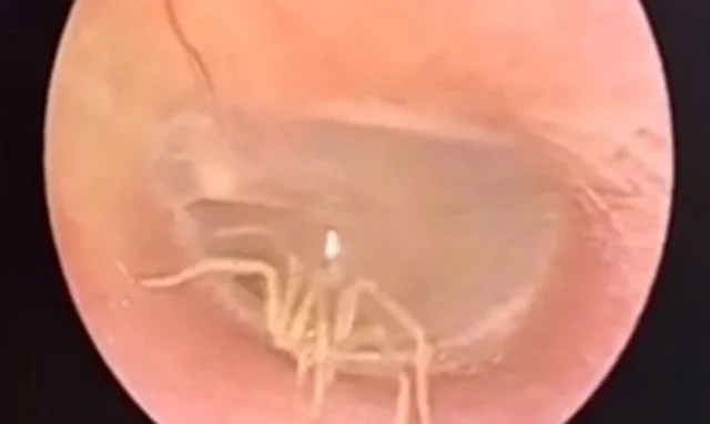 Ανατριχιαστικό: Γιατρός ανακάλυψε αράχνη στο αυτί μιας γυναίκας (βίντεο)