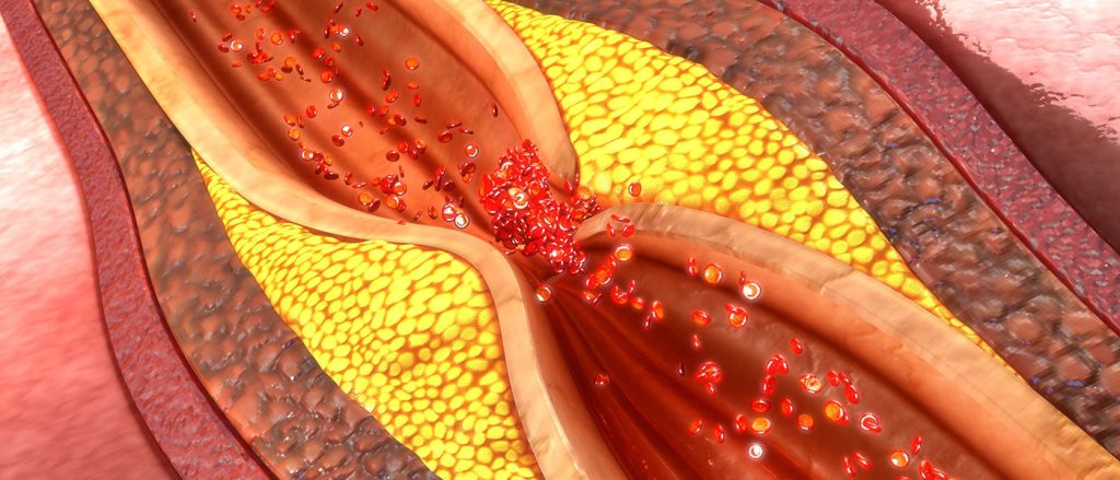 Μελέτη: Ο ιδανικός συνδυασμός για να μειώσετε την κακή χοληστερόλη