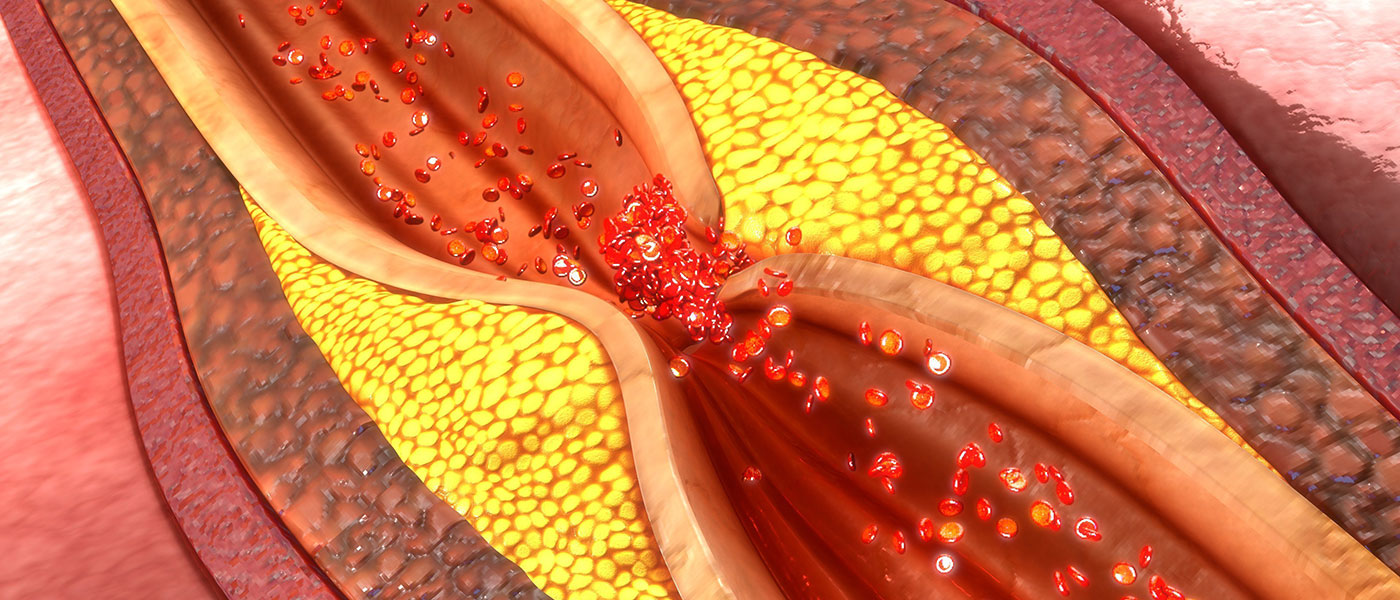 Μελέτη: Ο ιδανικός συνδυασμός για να μειώσετε την κακή χοληστερόλη