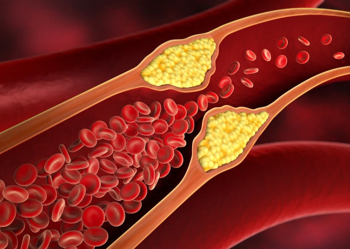 Υψηλή χοληστερίνη: Το ανησυχητικό σημάδι στα πόδια