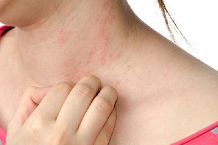 Αλλεργίες σε φάρμακα: Ποιες είναι οι πιο συχνές και ποια σημάδια σας προειδοποιούν
