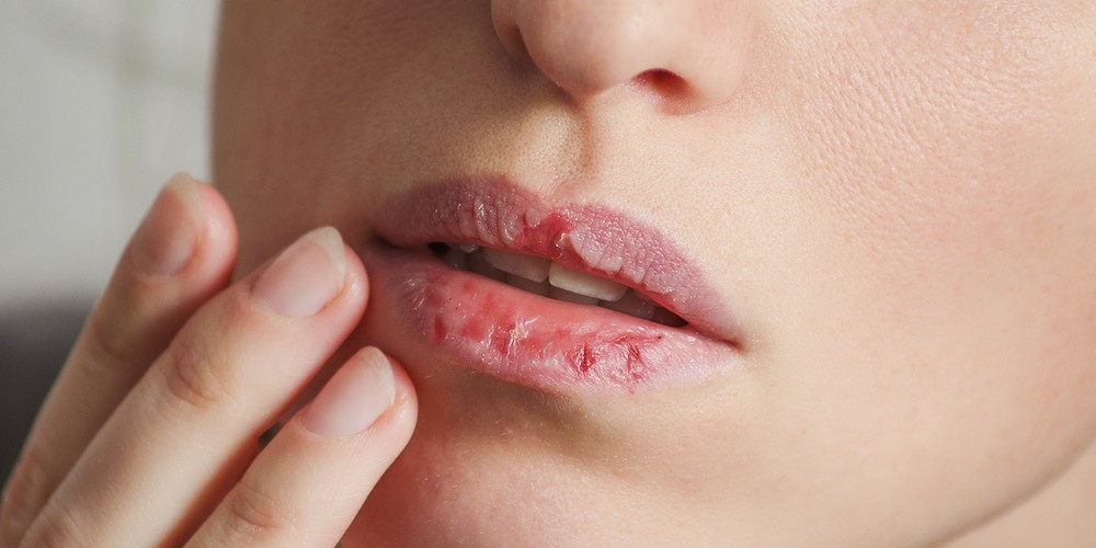 Σκασμένα χείλη: Τα συστατικά που θα σε βοηθήσουν να «σώσεις» την κατάσταση