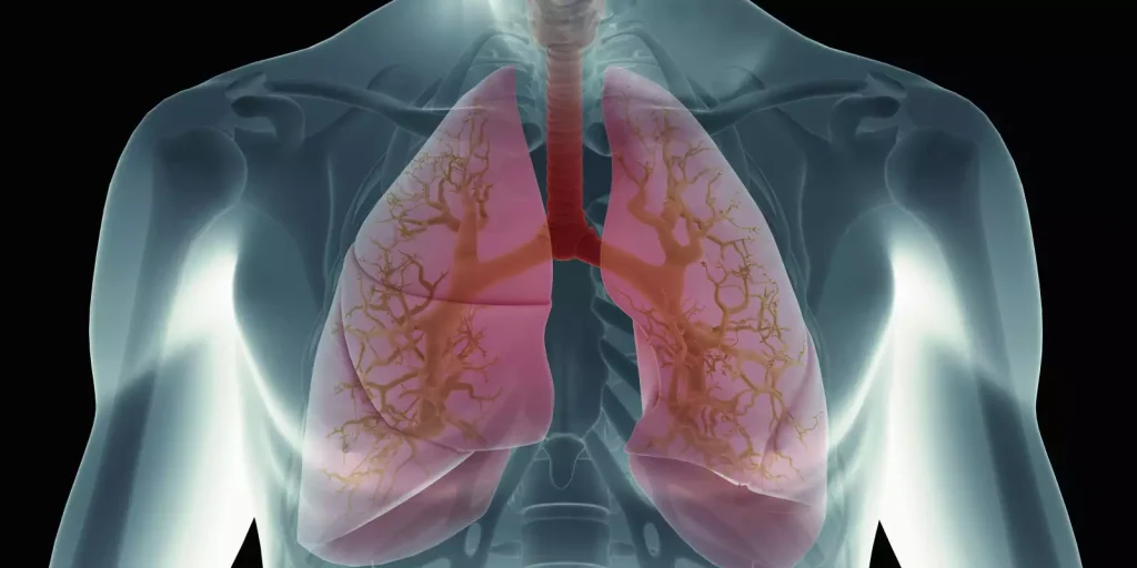 Πνευμονικό οίδημα: Πώς συνδέεται με την καρδιά η συσσώρευση υγρού στον πνεύμονα;