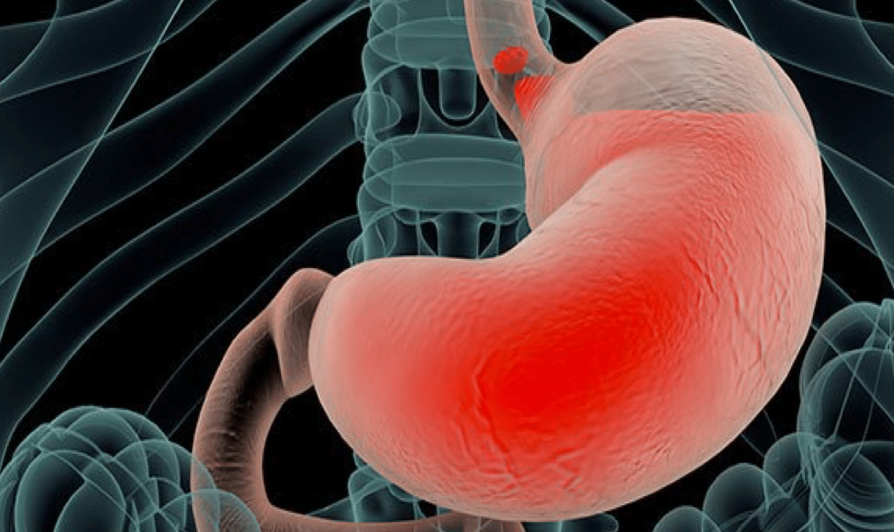 Γαστρορραγία: Τα συμπτώματα που σας προειδοποιούν ότι πάσχετε