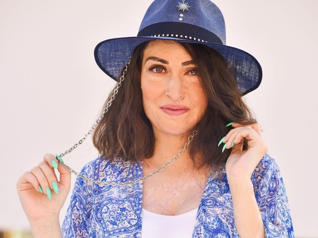 Τρία χρόνια από την επίθεση με βιτριόλι στην Ι.Παλιοσπύρου – Δείτε εικόνες από τα χειρουργεία (σκληρές φώτο)