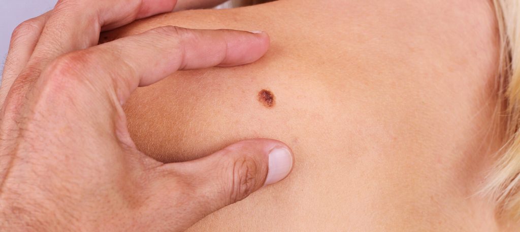 Πώς να αντιμετωπίσετε μια ελιά στο δέρμα που αιμορραγεί – Η πιθανότητα καρκίνου