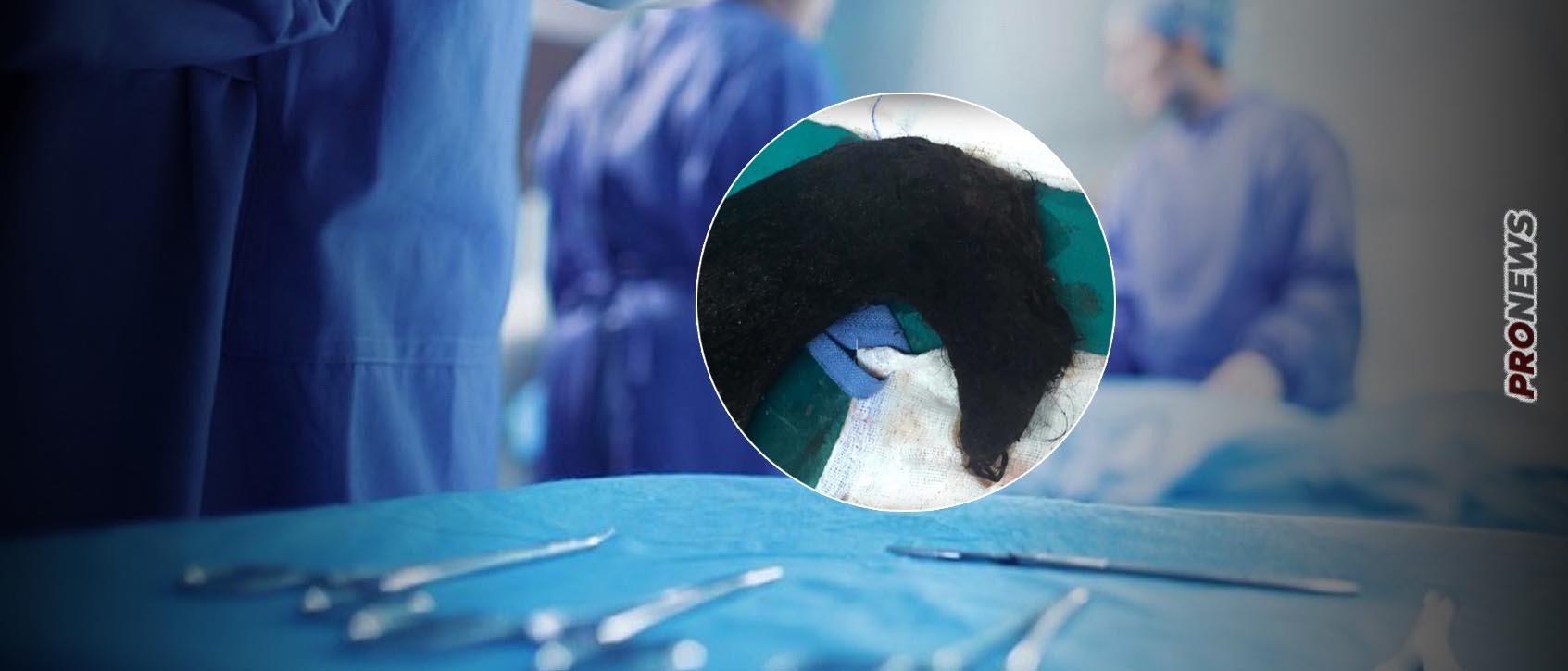 Σύνδρομο Ραπουνζέλ: Δείτε τη μάζα από τρίχες που αφαίρεσαν από το στομάχι της 14χρονης (φωτό)