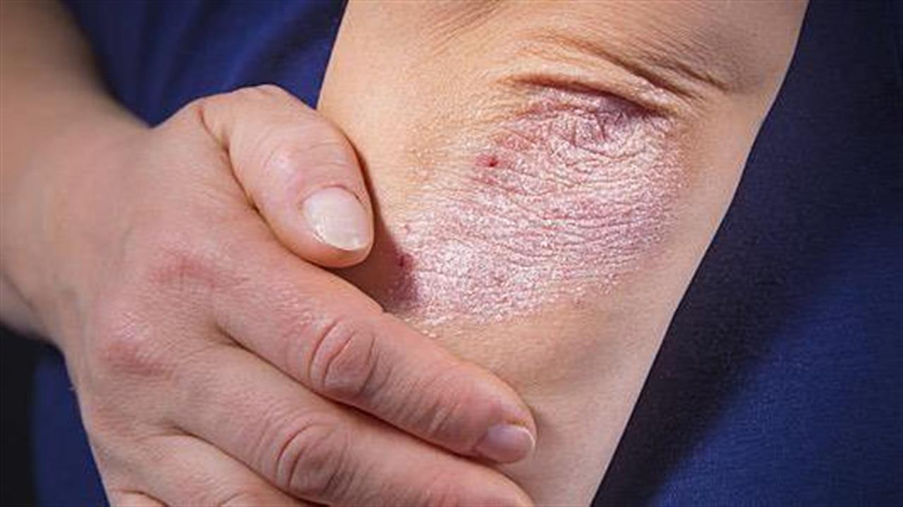 Καρδιακά προβλήματα και ψωρίαση: Πώς συνδέονται;