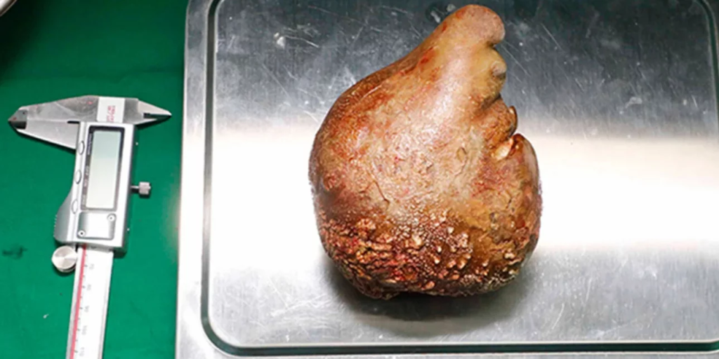 Αυτή είναι η μεγαλύτερη πέτρα που αφαιρέθηκε από τα νεφρά ασθενή – Ζυγίζει… 801γραμ. και έχει 13εκ. μήκος!