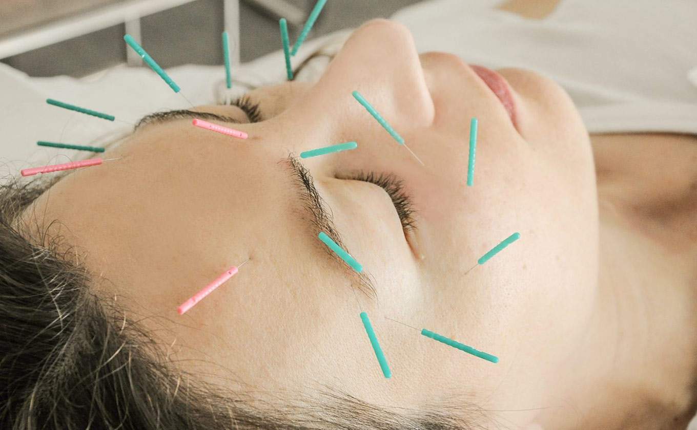 Όλα όσα πρέπει να γνωρίζεις για τον βελονισμό προσώπου