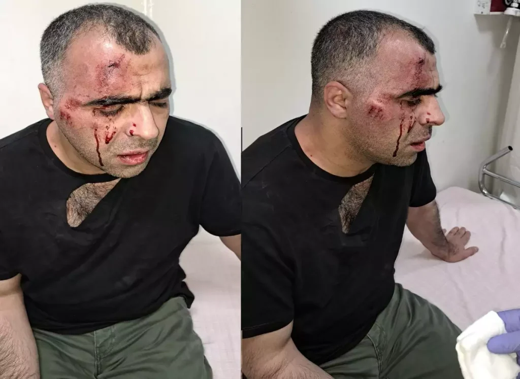 Τουρκία: Δημοσιογράφος έπεσε θύμα άγριου ξυλοδαρμού από σωματοφύλακες δημάρχου