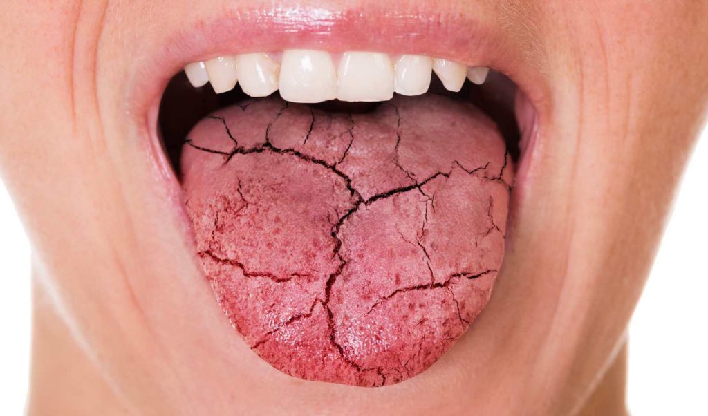 Ξηροστομία: Τι την προκαλεί και πώς αντιμετωπίζεται;