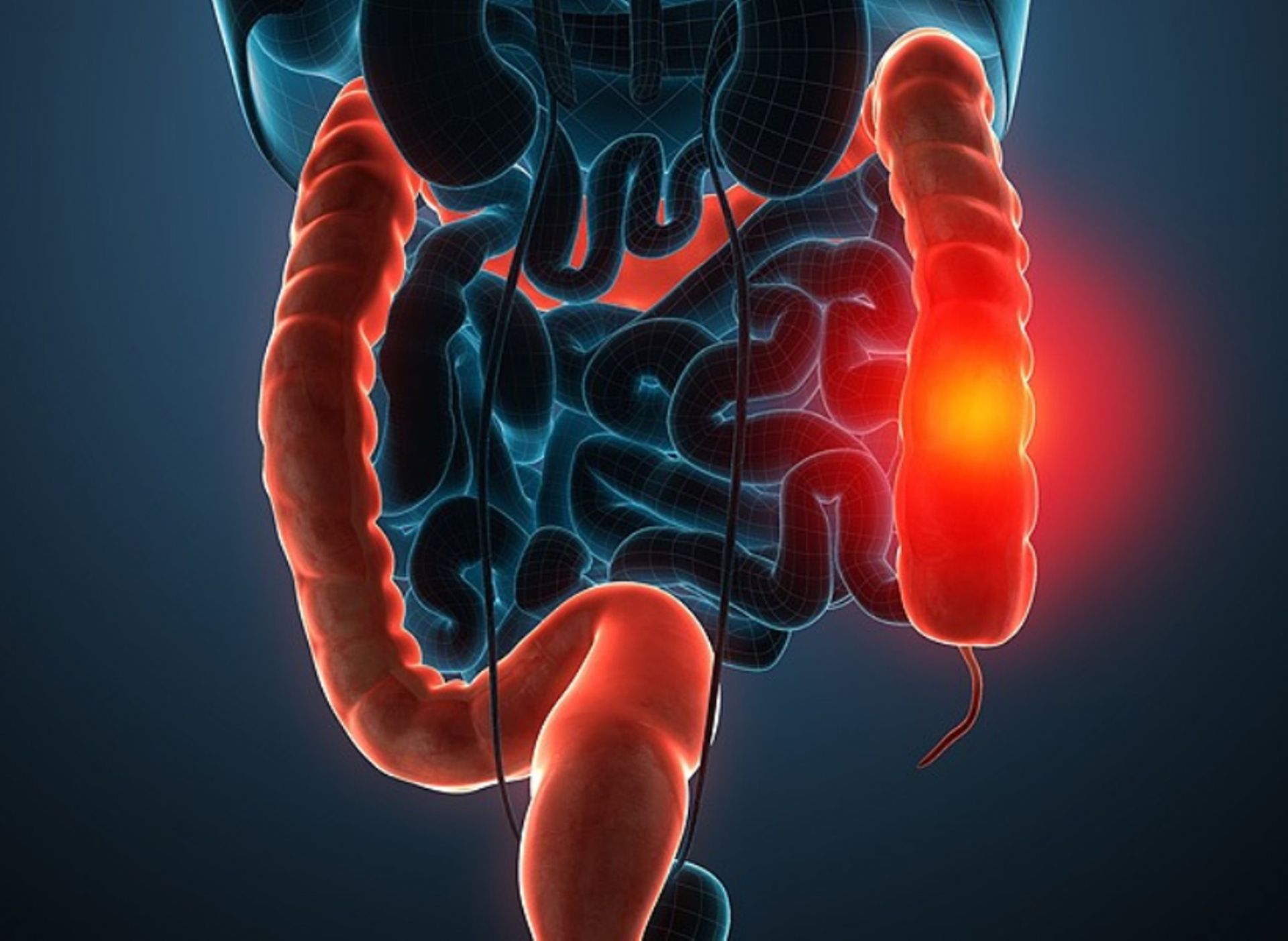 Τα συμπτώματα του καρκίνου στο έντερο που μοιάζουν με άλλες ασθένειες