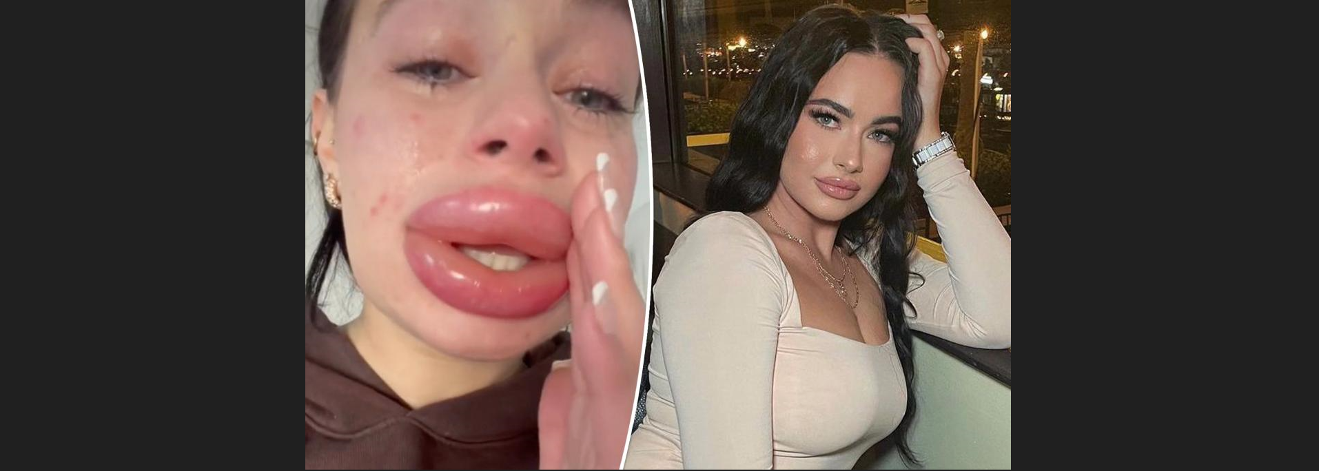 Έβαλε δωρεάν υαλουρονικό στα χείλη και την «πάτησε» – Τι συνέβη (βίντεο)