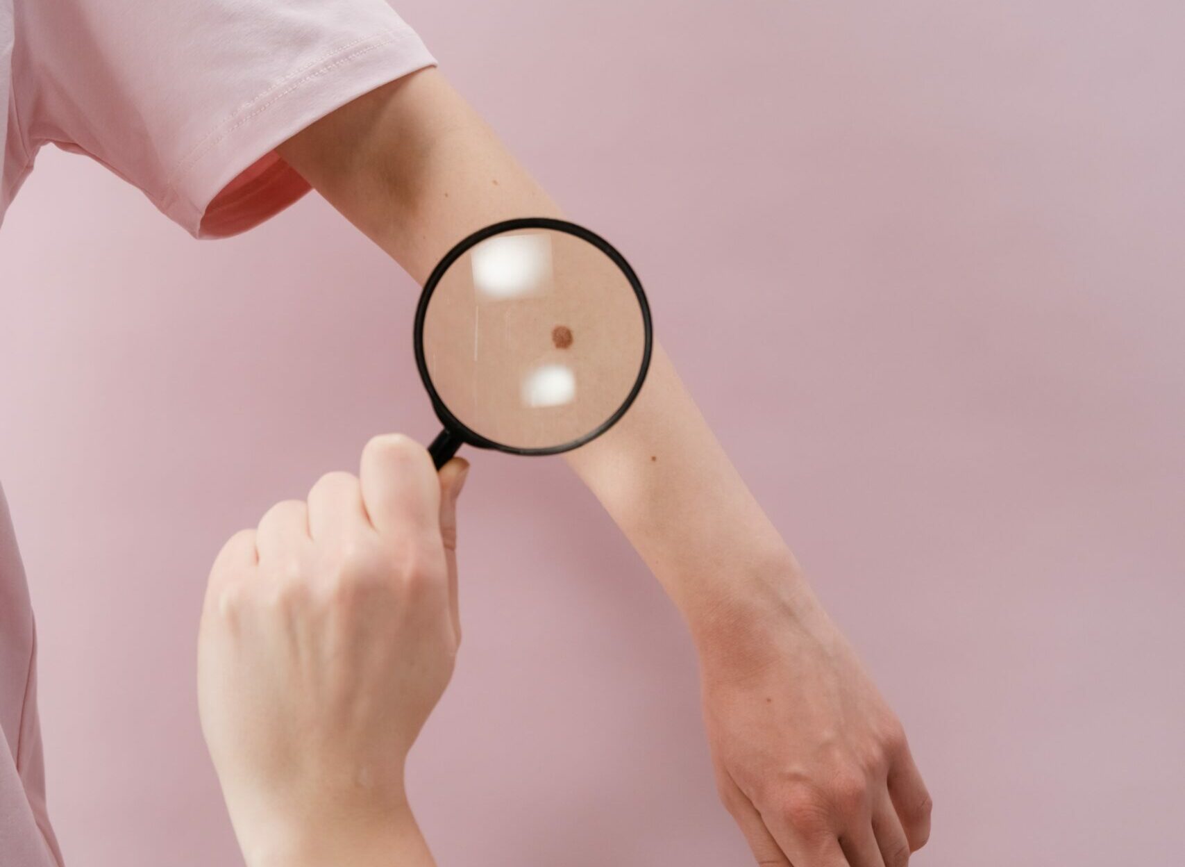 Πώς μοιάζει στην όψη το επιφανειακό μελάνωμα; – Πώς αντιμετωπίζεται και πώς αποτρέπεται; (φώτο)