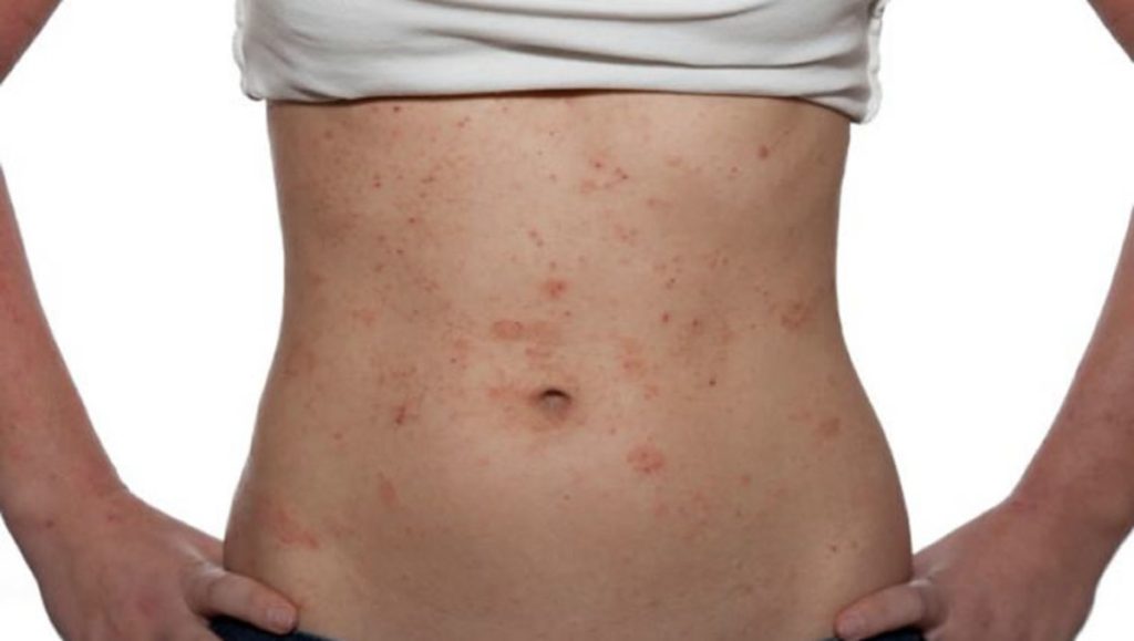 Τι είναι η διαπυητική ιδρωταδενίτιδα; – Τα συμπτώματα και η αντιμετώπιση