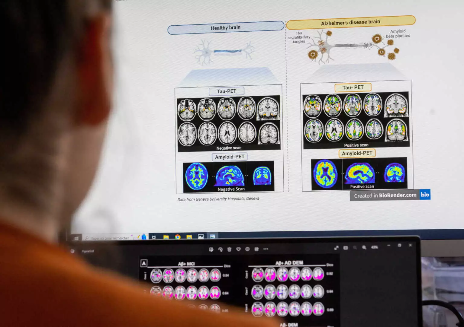 Εργαλείο τεχνητής νοημοσύνης αποκωδικοποιεί το γονιδίωμα του καρκίνου του εγκεφάλου κατά την διάρκεια επεμβάσεων