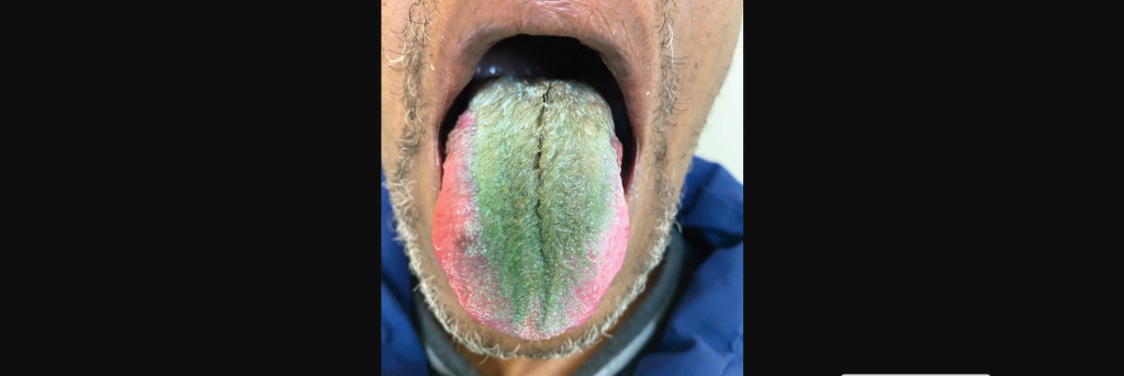 Σύνδρομο τριχωτής γλώσσας: 64χρονος το εμφάνισε λόγω σπάνιας παρενέργειας καπνίσματος και λήψης αντιβιοτικών