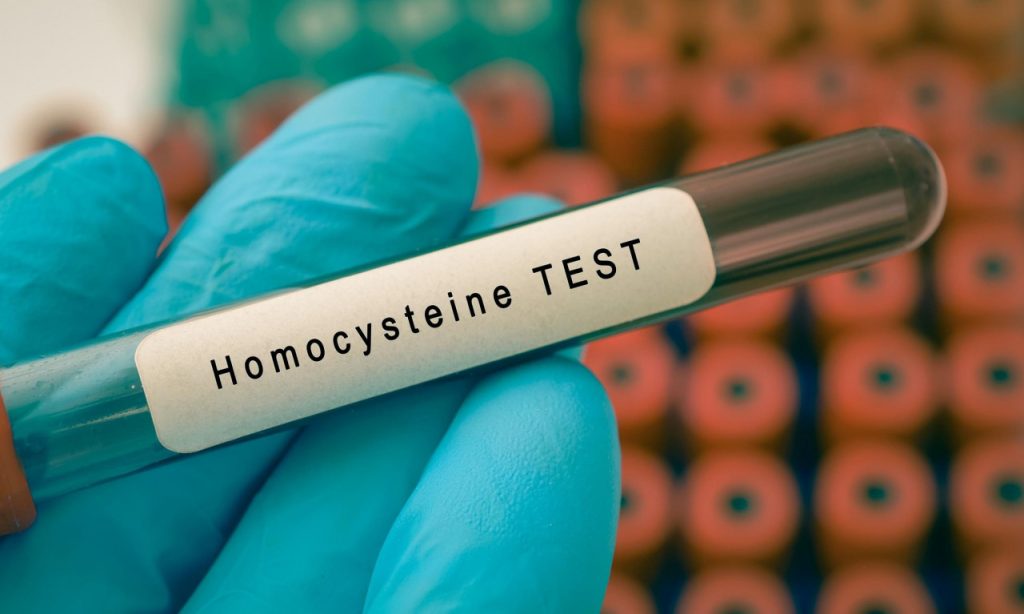 Ομοκυστεΐνη: Τι είναι αίματος και γιατί πρέπει να προσέχετε τις υψηλές τιμές