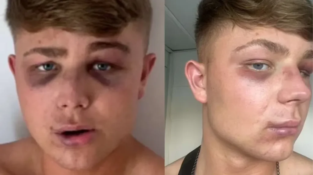 Λαγανάς: «Με σακάτεψαν για μια selfie» καταγγέλλει ο 18χρονος Βρετανός τουρίστας