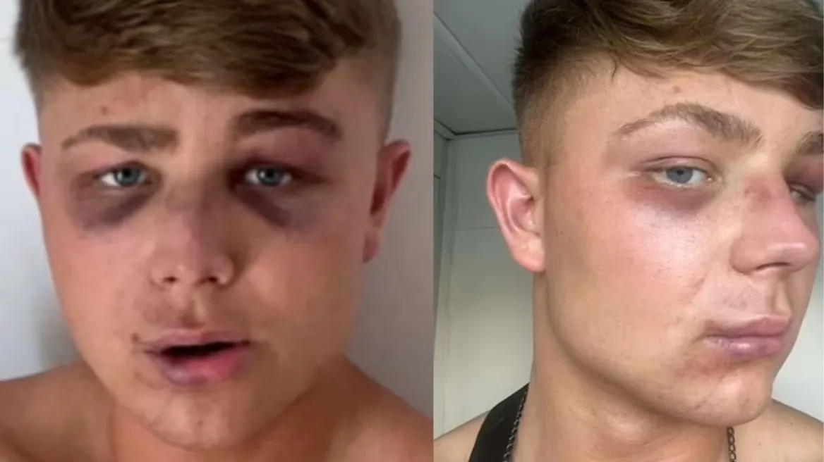 Λαγανάς: «Με σακάτεψαν για μια selfie» καταγγέλλει ο 18χρονος Βρετανός τουρίστας