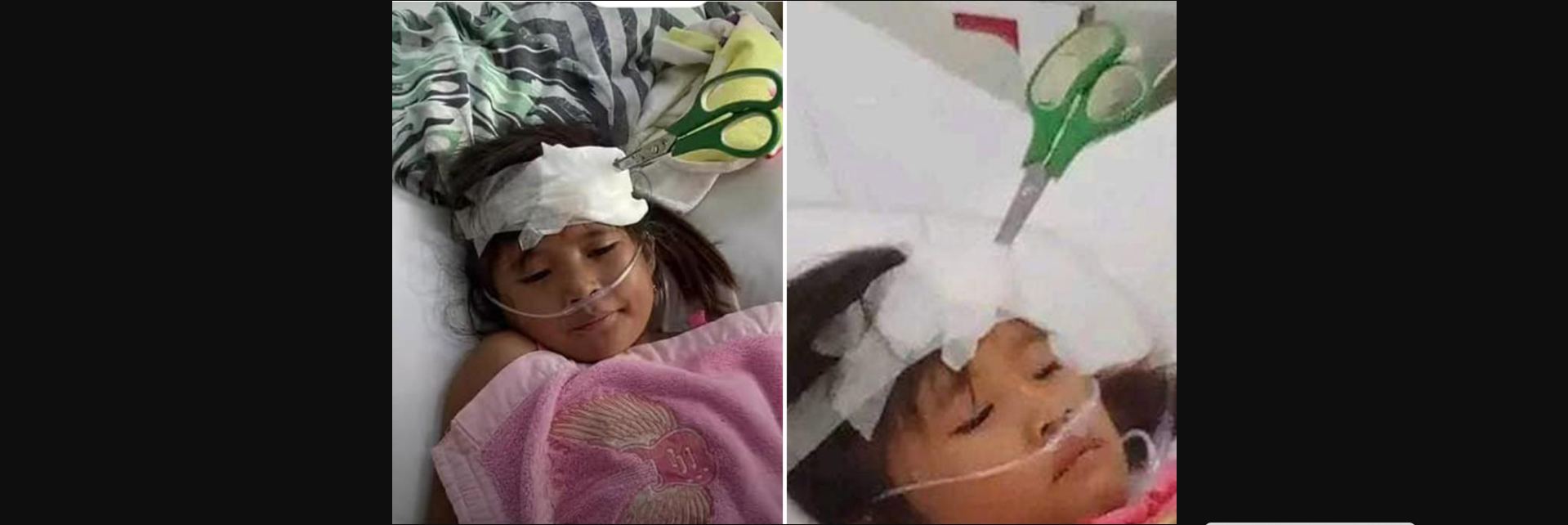 Φιλιππίνες: Απίστευτο θέαμα – 9χρονο κορίτσι διακομίσθηκε στο νοσοκομείο με ψαλίδι καρφωμένο στο κεφάλι της