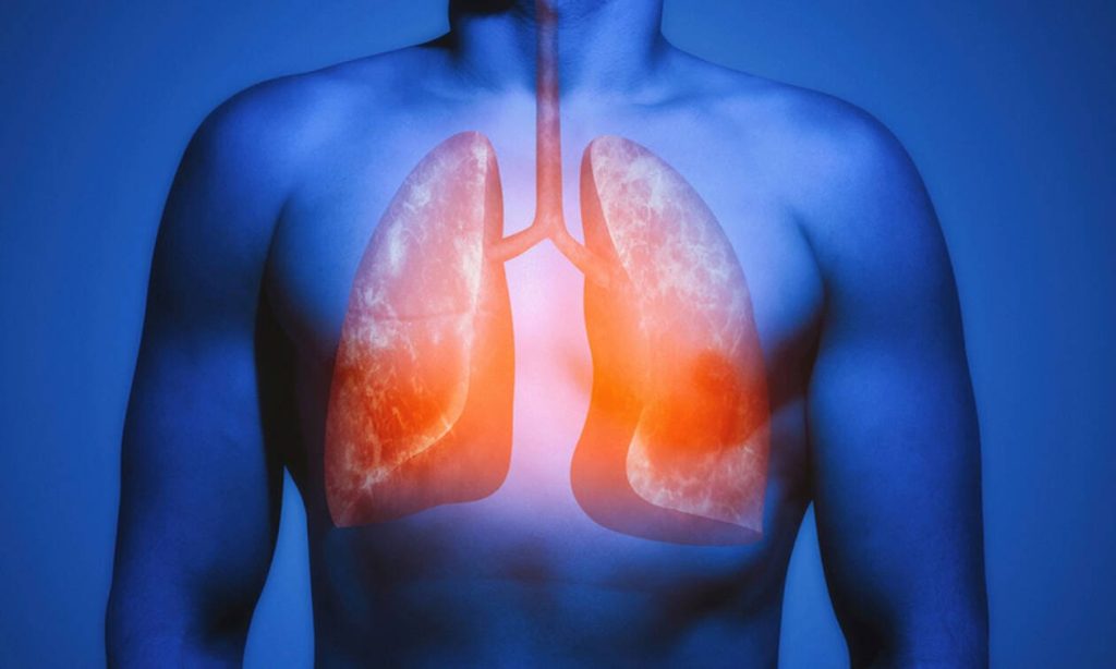 Νέα μελέτη: Τα οφέλη που έχουν για τους πνεύμονες τα ωμέγα-3 λιπαρά