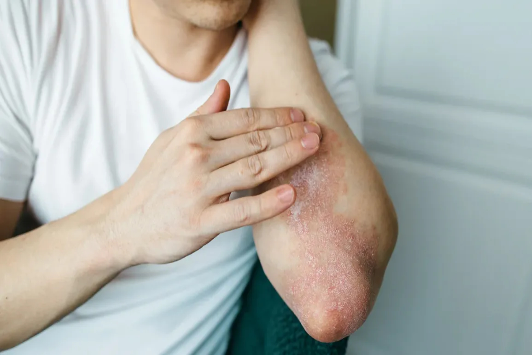 Ψωρίαση: Αυτή η βιταμίνη μπορεί να μειώσει την σοβαρότητα της πάθησης σύμφωνα με τους ειδικούς