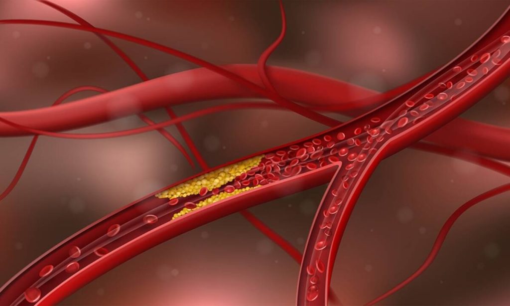 Πώς θα καταλάβετε ότι έχετε φραγμένες αρτηρίες;