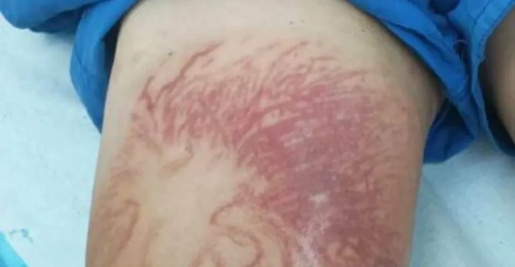 Κόρινθος: Τι είναι η θαλάσσια ανεμώνη που τσίμπησε 9χρονο στο πόδι – Πόσο επικίνδυνη είναι