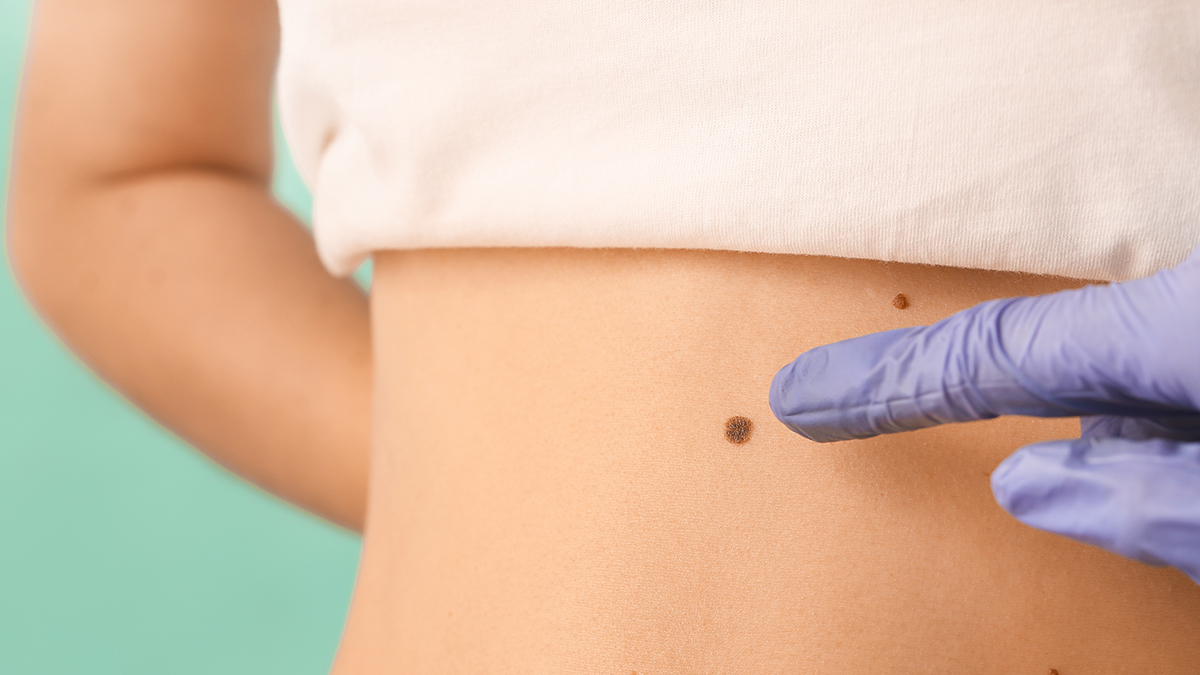 Κρεατοελιές: Όλα όσα πρέπει να γνωρίζετε για την αφαίρεσή τους – Οι τρεις τρόποι