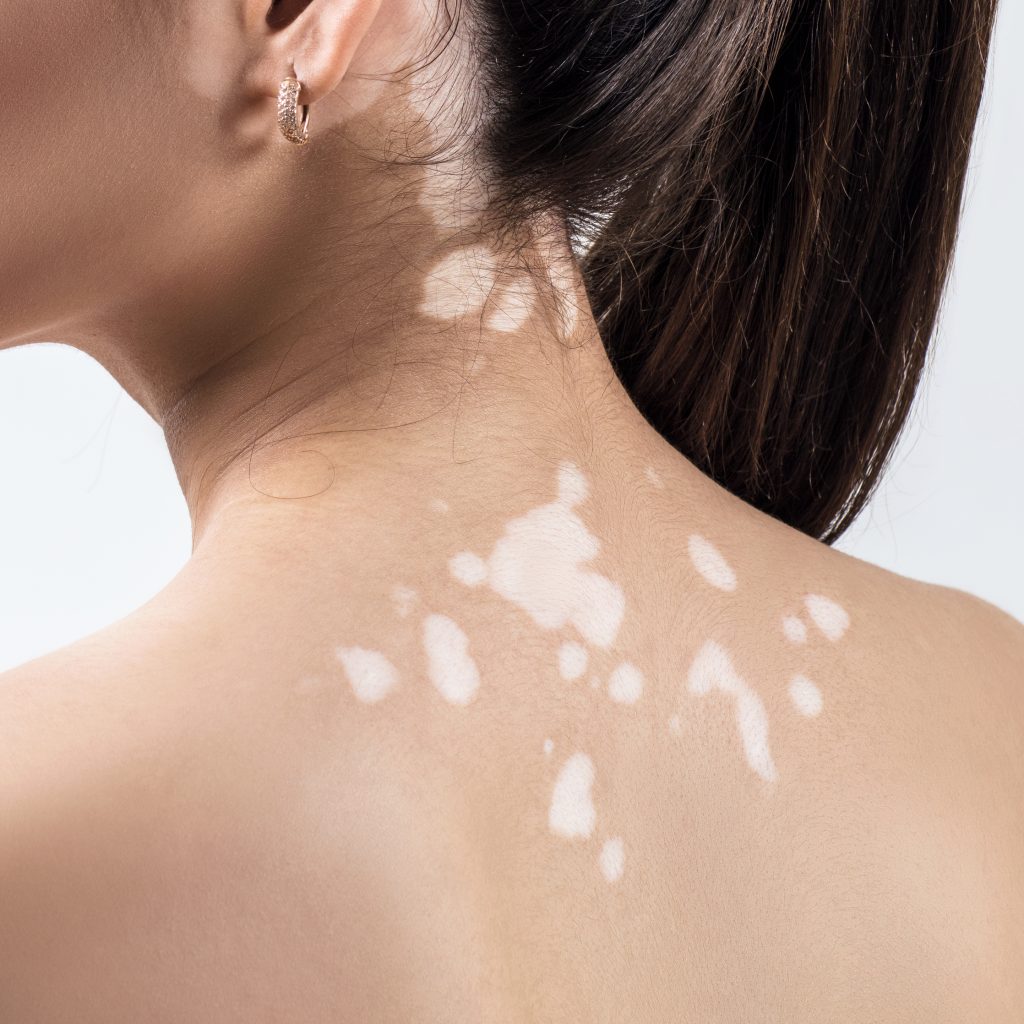 Λευκές κηλίδες στο δέρμα: Ποιες είναι οι πιθανές αιτίες τους