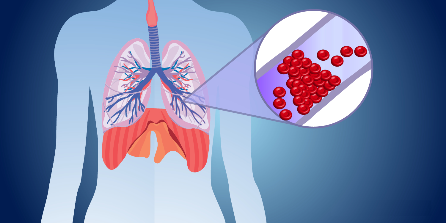 Πνευμονική εμβολή: Ποια είναι τα συμπτώματα και οι πιθανές επιπλοκές