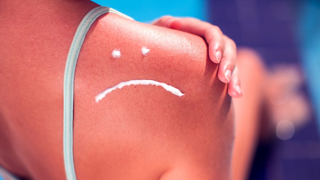 Προσοχή: Μην βάζετε ποτέ βαζελίνη ή βούτυρο στο ηλιακό έγκαυμα – Πότε πρέπει να πάτε στο γιατρό