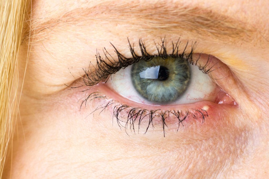 Κριθαράκι στο μάτι: Αίτια και πρόληψη – Πώς να το αντιμετωπίσετε
