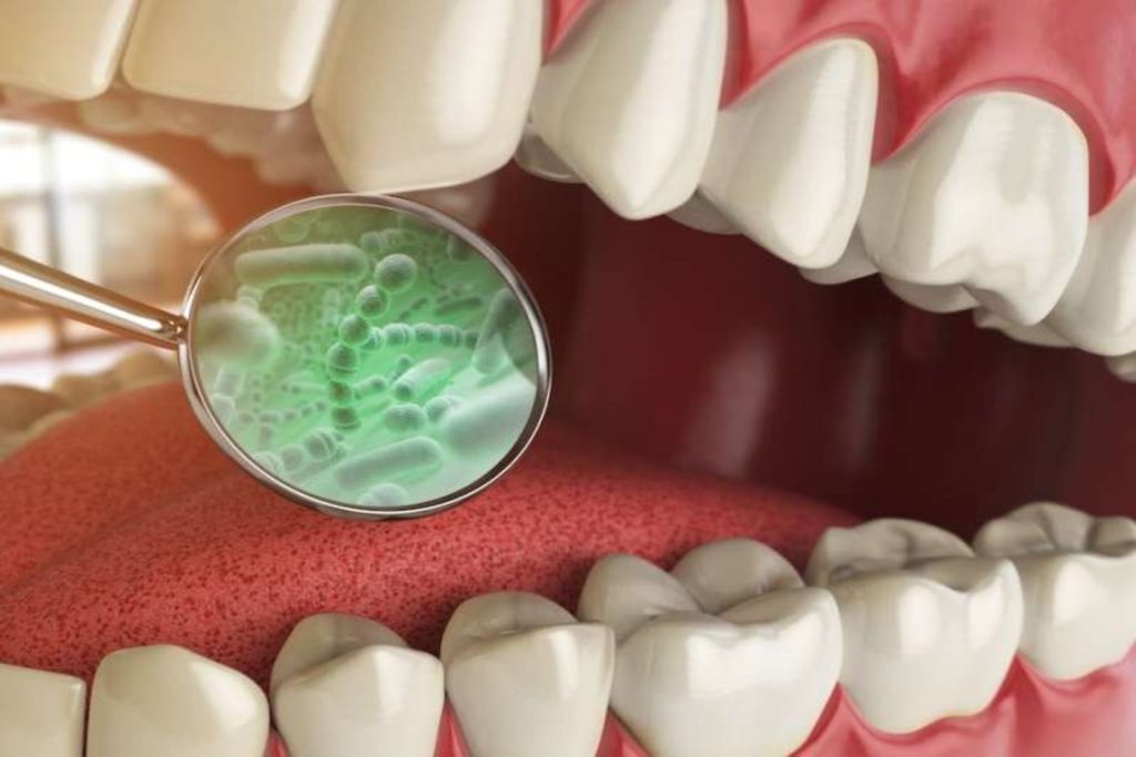 Νέα έρευνα: Δείτε πώς η νόσος του Crohn συνδέεται με τα βακτήρια του στόματος