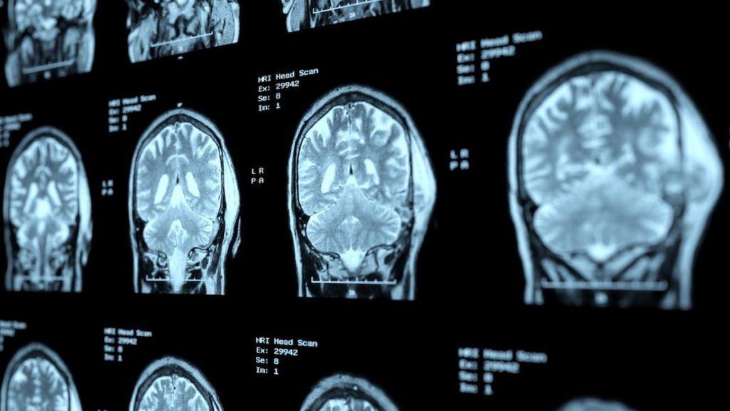 Νέες δυνατότητες για διάγνωση και θεραπεία νευρολογικών παθήσεων όπως το Αλτσχάιμερ