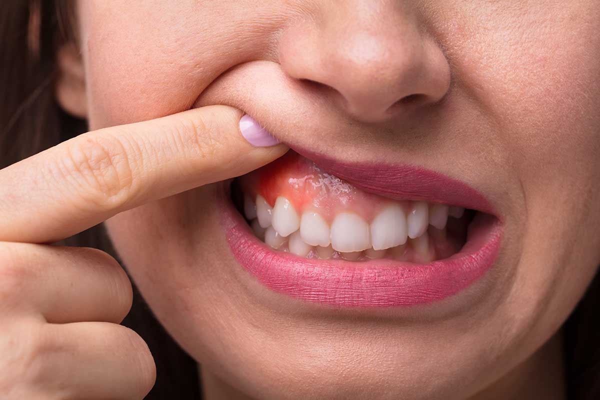 Καρκίνος του στόματος: Τα πρώτα σημάδια που δεν πρέπει να αγνοείτε