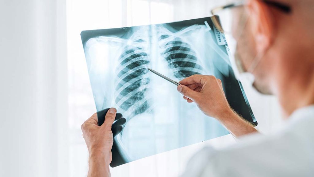 Όζος στον πνεύμονα: Δείτε τι είναι και πώς αντιμετωπίζεται – Προκαλεί συμπτώματα;